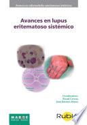 Avances en lupus eritematoso sistémico